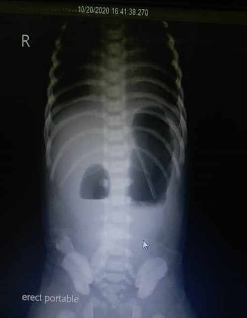 CASES OF THE WEEK – “Rare case of male baby with Down syndrome & duodenal atresia (antenatal finding) & operated at 26 hours of life” by Dr Wissam AlTamr, Specialist Paediatric Surgery 01